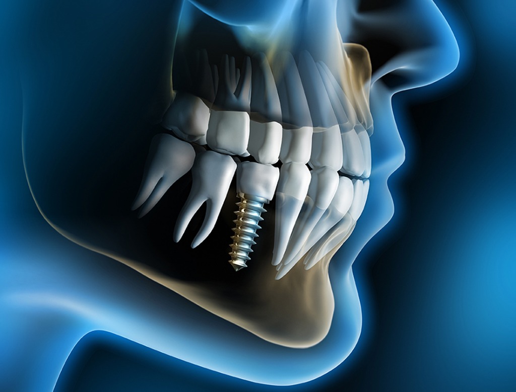 Dental Implants