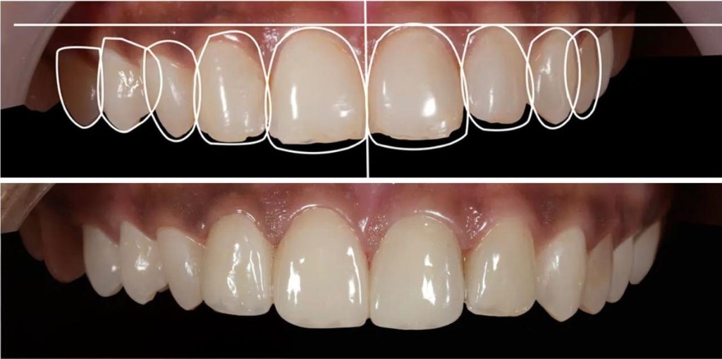 Smile Makeover