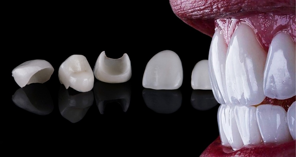 Porcelain Veneers